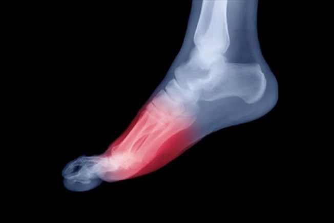 Custom Orthotics in Mississauga