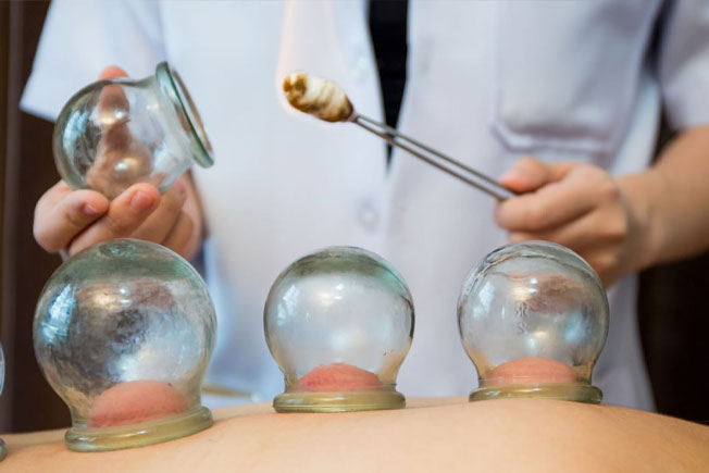 Fire Cupping in Mississauga