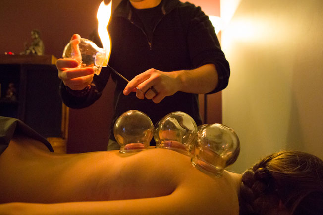 Fire Cupping in Mississauga